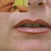 vignettes/esthetique/avant-apres-levres.jpg